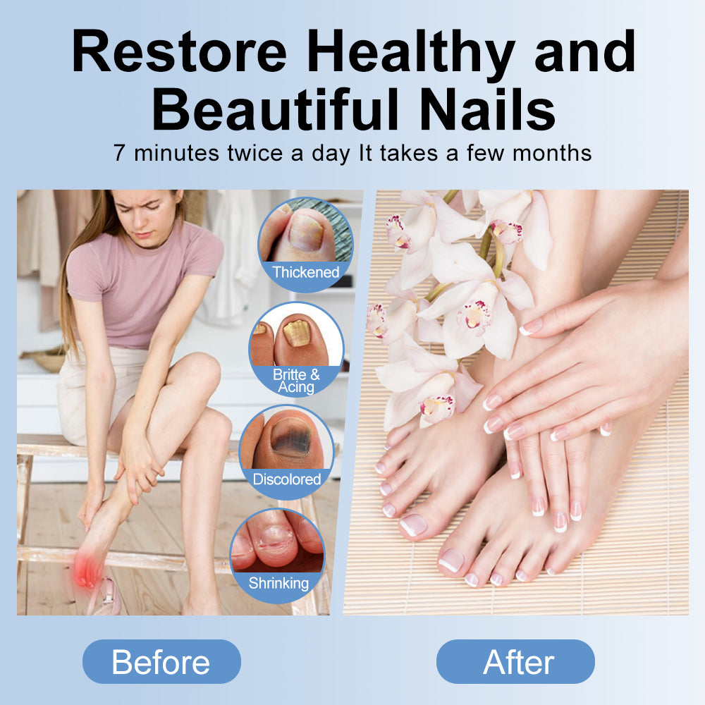 LED Light Nail Treatment ,Nail Fungus Treatment Device, Foldable Home Care For Discolored & Thickened Toenails Fingernails, Suitable For Home & Travel Use
